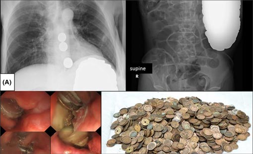 ياباني يبتلع 8 كلغ من القطع النقدية